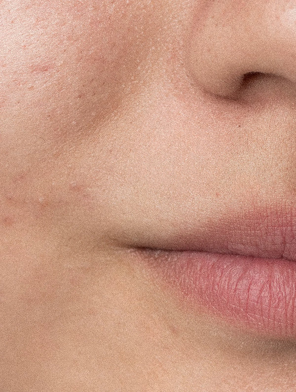 Blemish-Prone Skincare